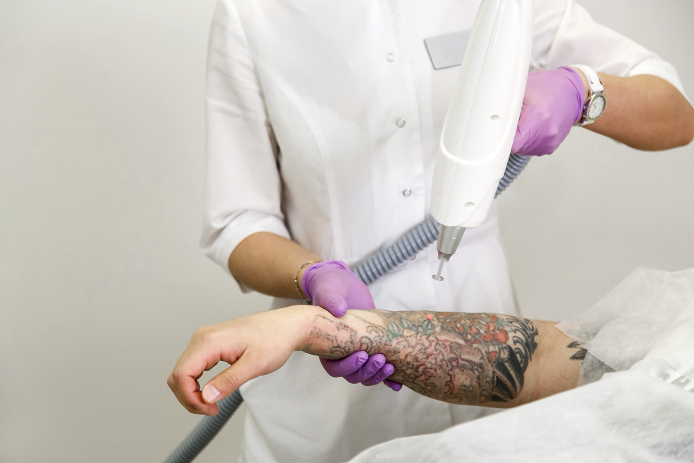 Enlever un tatouage au laser : bonne ou mauvaise idée ?