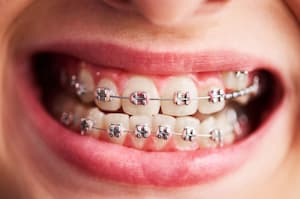 appareil dentaire - brackets metalliques